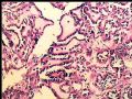 左肾肿瘤－－乳头状肾细胞癌图7