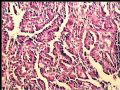 左肾肿瘤－－乳头状肾细胞癌图8