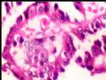 左肾肿瘤－－乳头状肾细胞癌图9