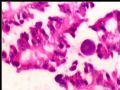 左肾肿瘤－－乳头状肾细胞癌图10