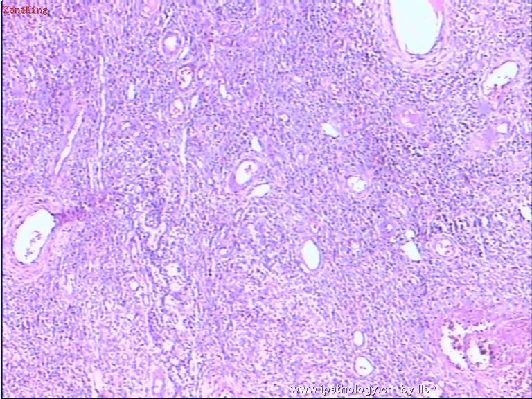 子宫内膜间质肉瘤伴性索样分化图2