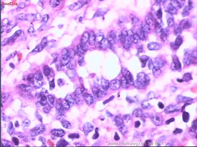 子宫内膜间质肉瘤伴性索样分化图6