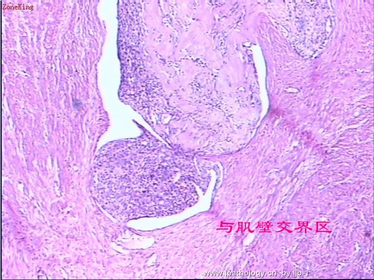 子宫内膜间质肉瘤伴性索样分化图8