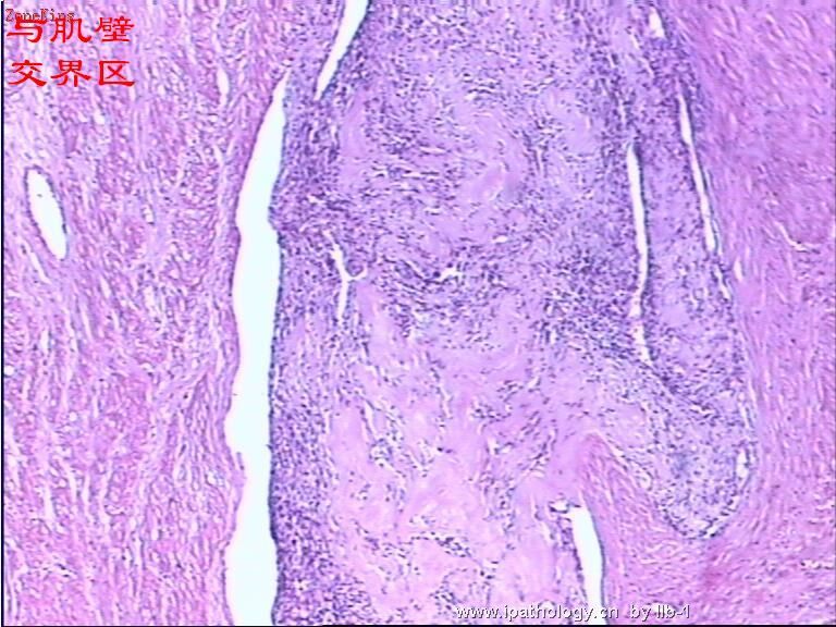 子宫内膜间质肉瘤伴性索样分化图9