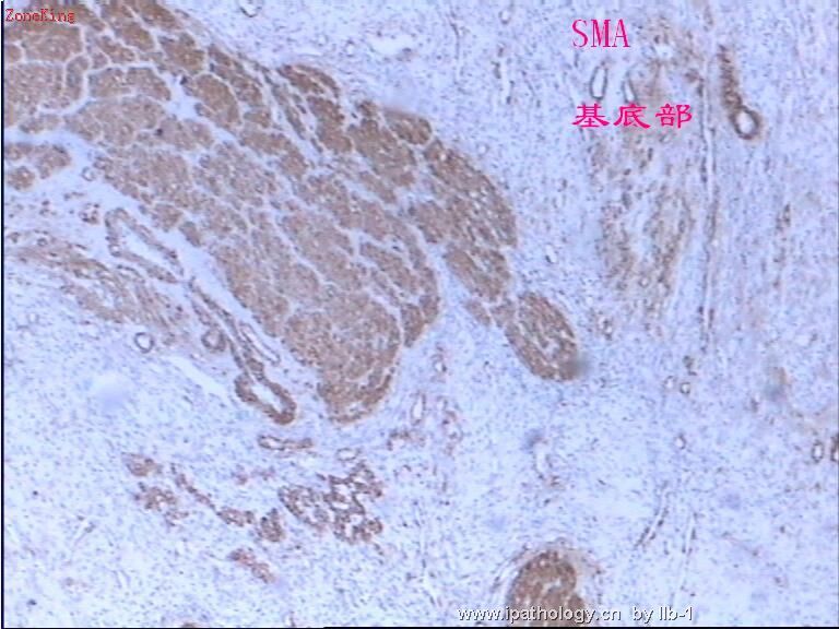 子宫内膜间质肉瘤伴性索样分化图10