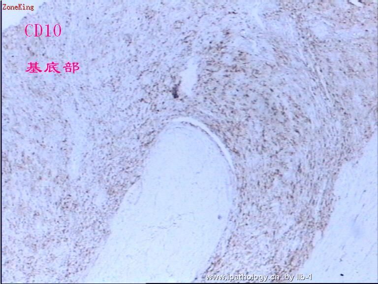 子宫内膜间质肉瘤伴性索样分化图12
