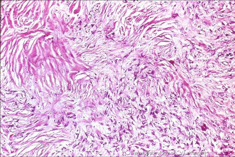 乳房肿块--低级别纤维瘤样癌（Low Grade Fibromatosis-like Ca）图1
