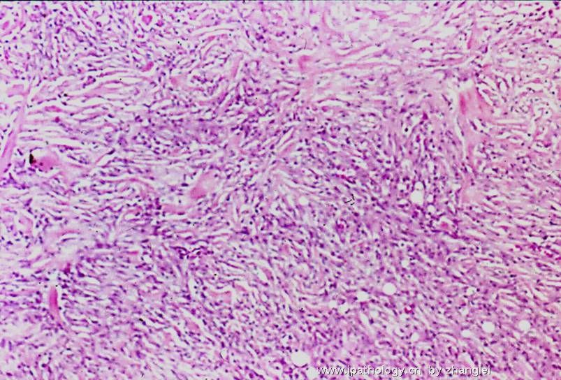 乳房肿块--低级别纤维瘤样癌（Low Grade Fibromatosis-like Ca）图2