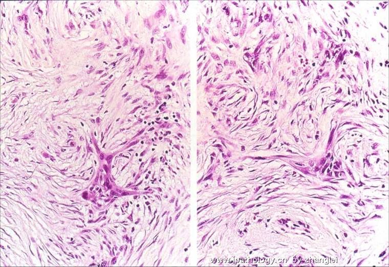 乳房肿块--低级别纤维瘤样癌（Low Grade Fibromatosis-like Ca）图3