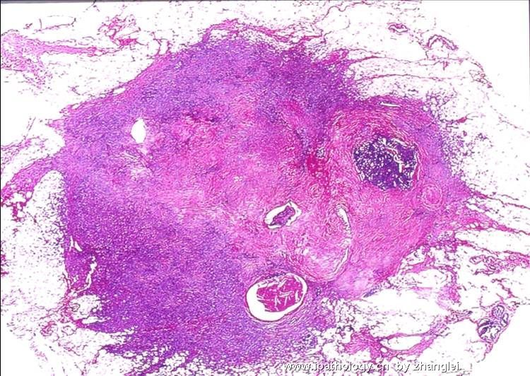 乳房肿块--低级别纤维瘤样癌（Low Grade Fibromatosis-like Ca）图4