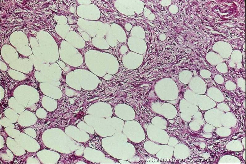 乳房肿块--低级别纤维瘤样癌（Low Grade Fibromatosis-like Ca）图5