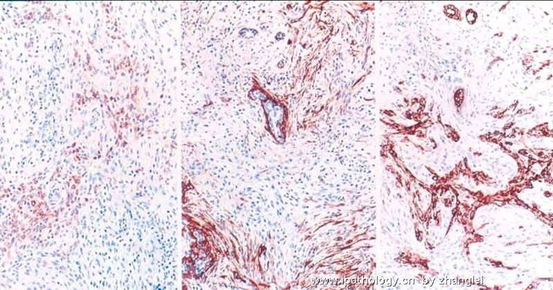 乳房肿块--低级别纤维瘤样癌（Low Grade Fibromatosis-like Ca）图6