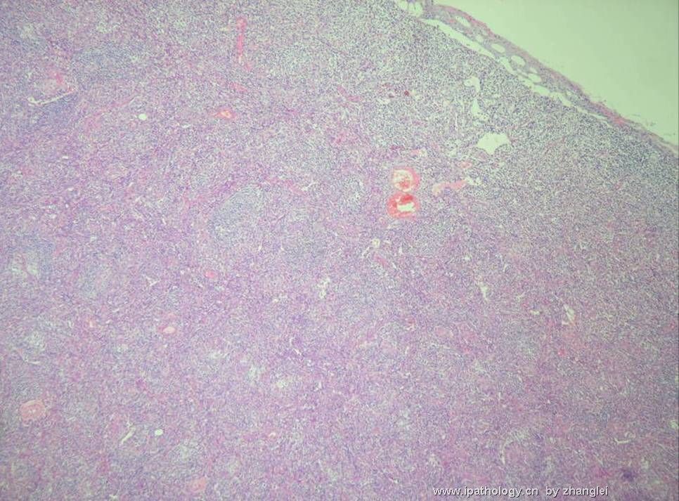 （转贴）颈部淋巴结--血管免疫母细胞性T细胞淋巴瘤（angioimmunoblastic T cell lymphoma）图1