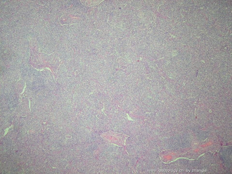 （转贴）颈部淋巴结--血管免疫母细胞性T细胞淋巴瘤（angioimmunoblastic T cell lymphoma）图2