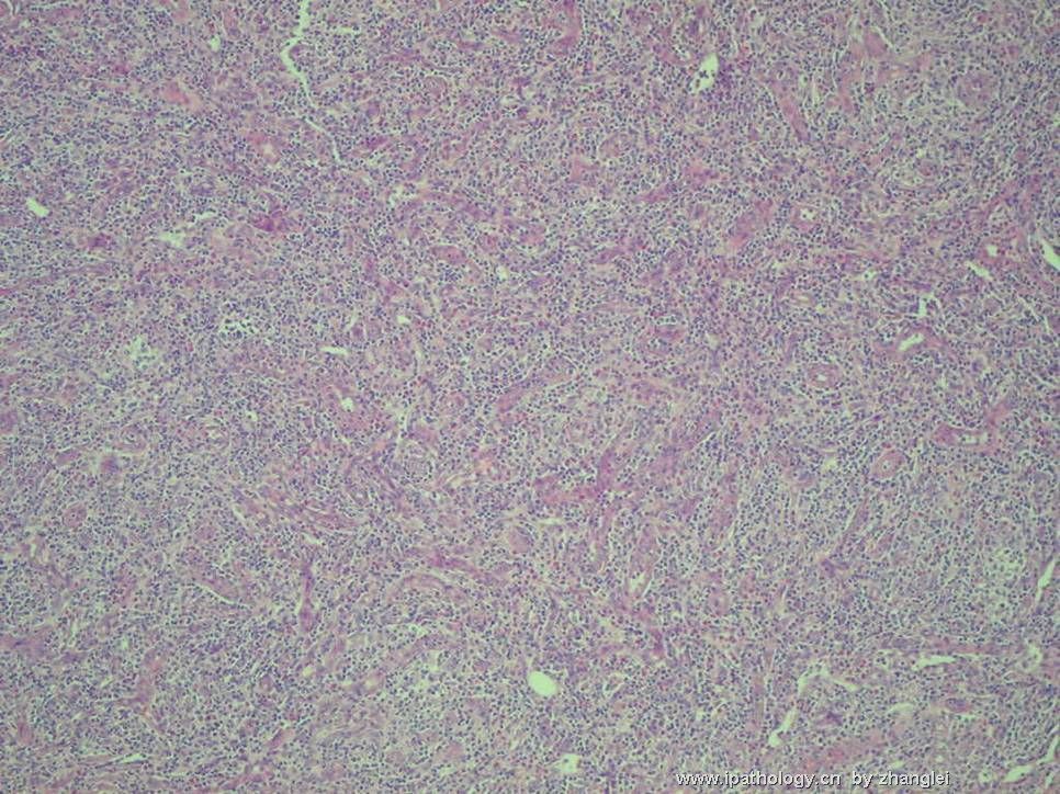 （转贴）颈部淋巴结--血管免疫母细胞性T细胞淋巴瘤（angioimmunoblastic T cell lymphoma）图3