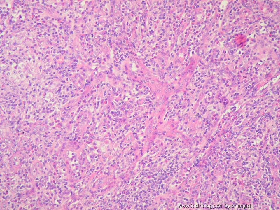 （转贴）颈部淋巴结--血管免疫母细胞性T细胞淋巴瘤（angioimmunoblastic T cell lymphoma）图4