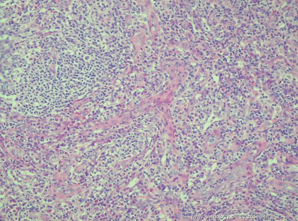 （转贴）颈部淋巴结--血管免疫母细胞性T细胞淋巴瘤（angioimmunoblastic T cell lymphoma）图5