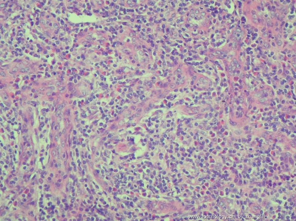 （转贴）颈部淋巴结--血管免疫母细胞性T细胞淋巴瘤（angioimmunoblastic T cell lymphoma）图6
