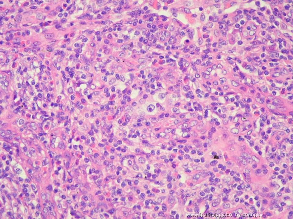 （转贴）颈部淋巴结--血管免疫母细胞性T细胞淋巴瘤（angioimmunoblastic T cell lymphoma）图7