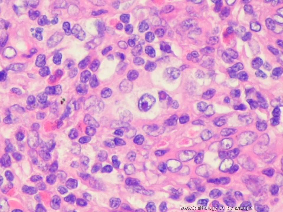 （转贴）颈部淋巴结--血管免疫母细胞性T细胞淋巴瘤（angioimmunoblastic T cell lymphoma）图8