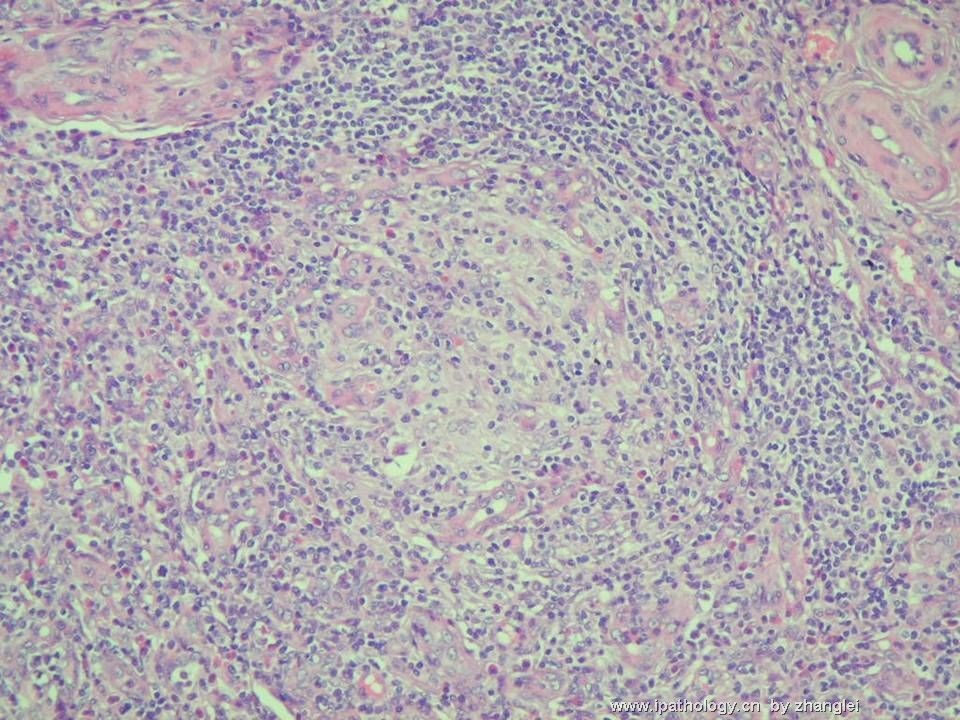 （转贴）颈部淋巴结--血管免疫母细胞性T细胞淋巴瘤（angioimmunoblastic T cell lymphoma）图9