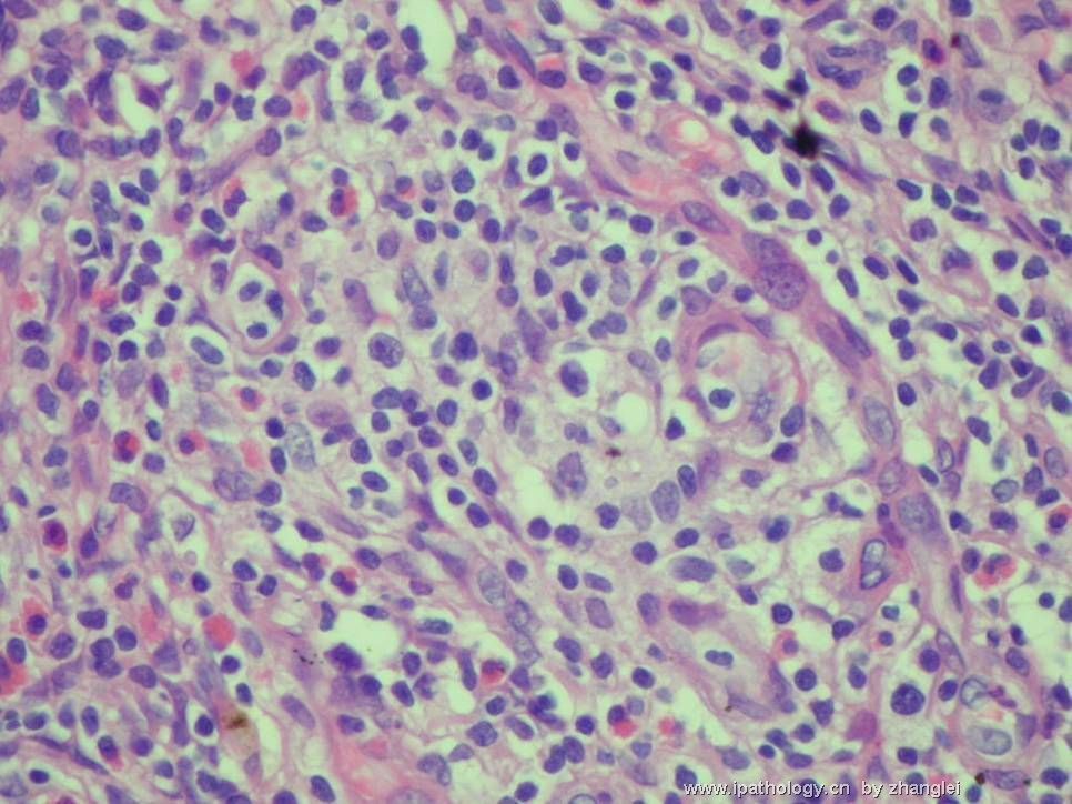 （转贴）颈部淋巴结--血管免疫母细胞性T细胞淋巴瘤（angioimmunoblastic T cell lymphoma）图10