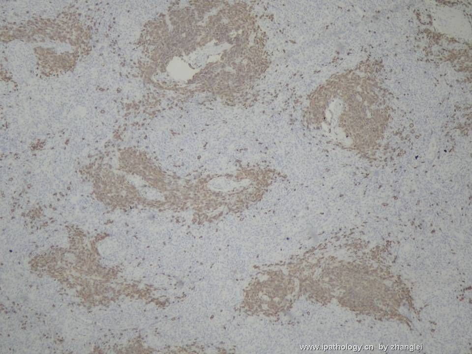 （转贴）颈部淋巴结--血管免疫母细胞性T细胞淋巴瘤（angioimmunoblastic T cell lymphoma）图11