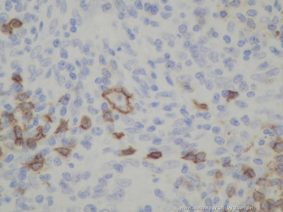 （转贴）颈部淋巴结--血管免疫母细胞性T细胞淋巴瘤（angioimmunoblastic T cell lymphoma）图12