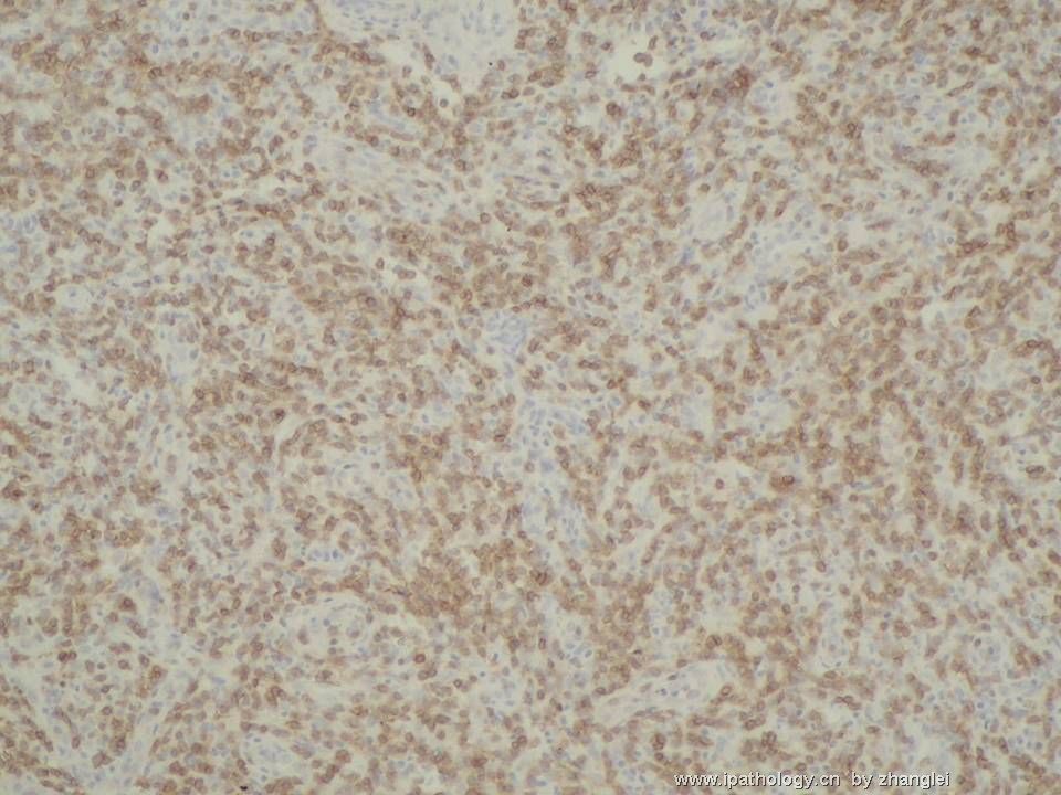 （转贴）颈部淋巴结--血管免疫母细胞性T细胞淋巴瘤（angioimmunoblastic T cell lymphoma）图13