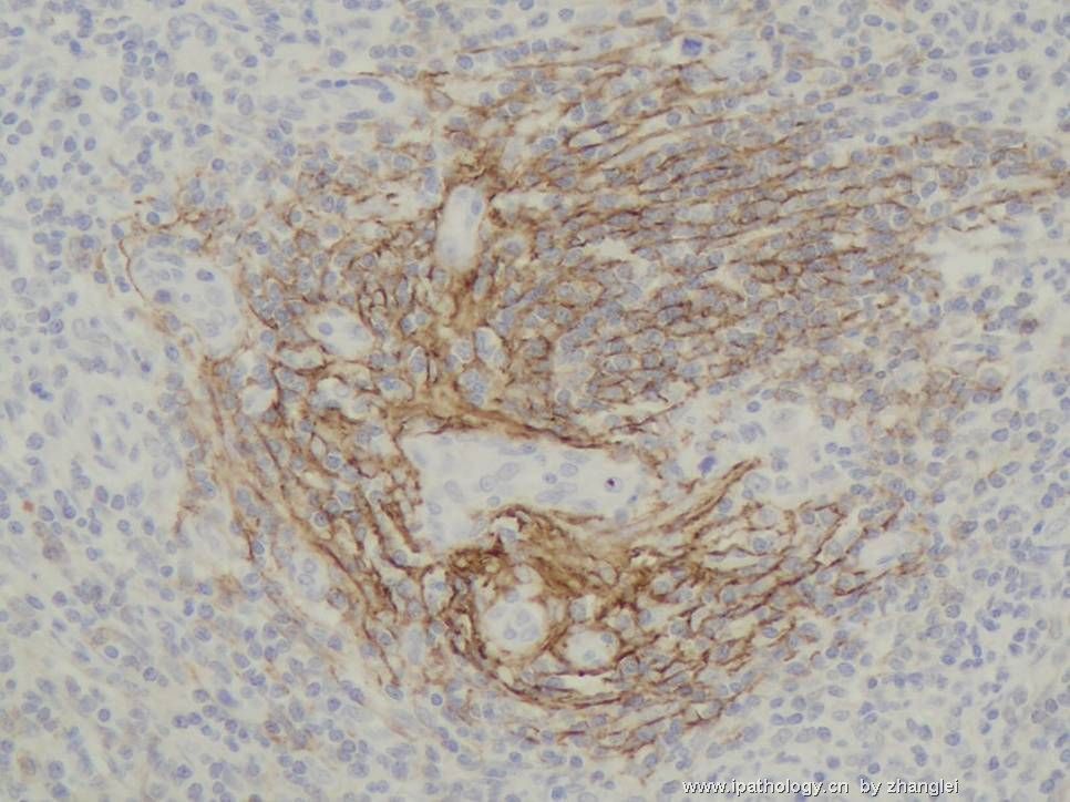 （转贴）颈部淋巴结--血管免疫母细胞性T细胞淋巴瘤（angioimmunoblastic T cell lymphoma）图15