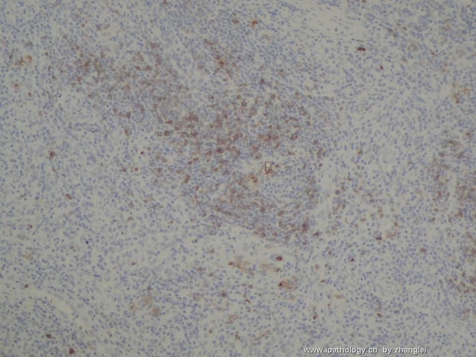 （转贴）颈部淋巴结--血管免疫母细胞性T细胞淋巴瘤（angioimmunoblastic T cell lymphoma）图16