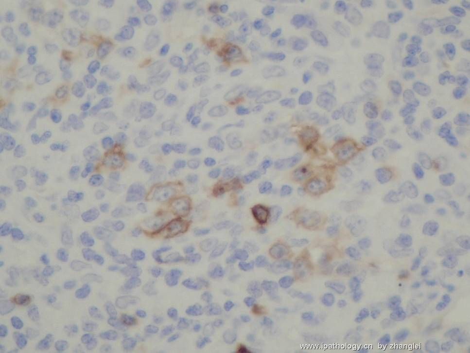 （转贴）颈部淋巴结--血管免疫母细胞性T细胞淋巴瘤（angioimmunoblastic T cell lymphoma）图17