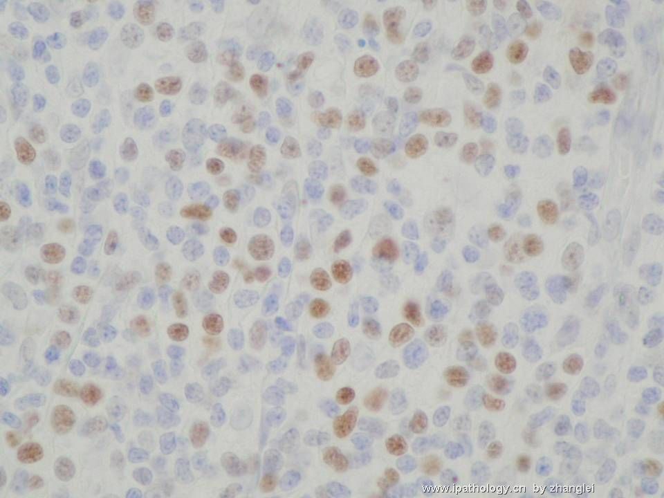（转贴）颈部淋巴结--血管免疫母细胞性T细胞淋巴瘤（angioimmunoblastic T cell lymphoma）图18