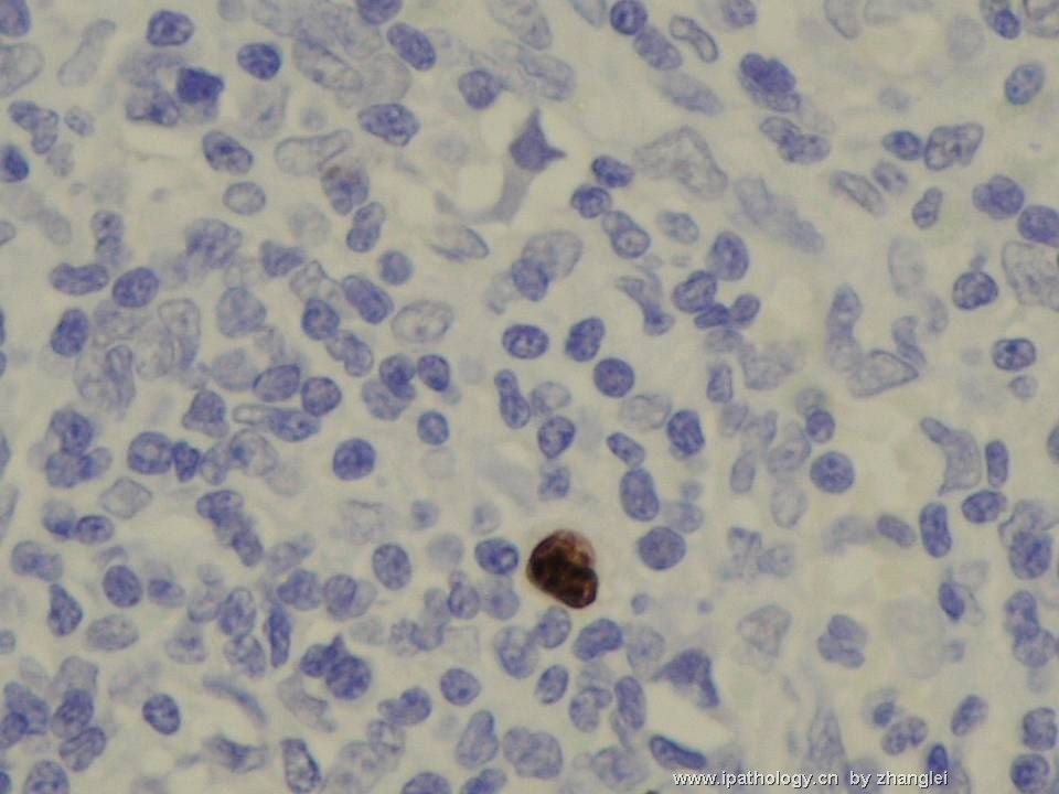 （转贴）颈部淋巴结--血管免疫母细胞性T细胞淋巴瘤（angioimmunoblastic T cell lymphoma）图19