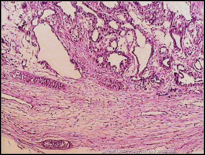 睾丸肿瘤－－卵黄囊瘤（yolk sac tumor）图1