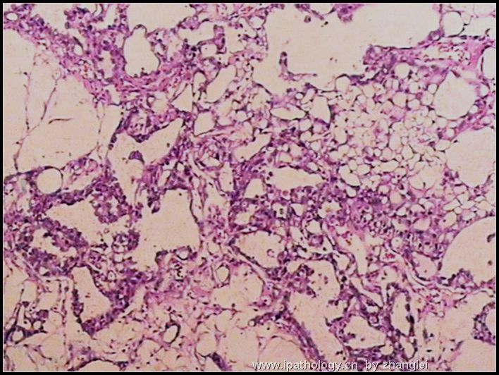 睾丸肿瘤－－卵黄囊瘤（yolk sac tumor）图2