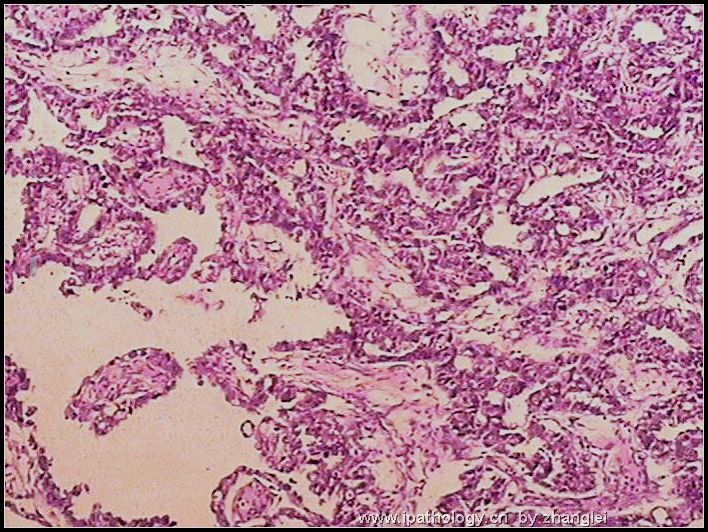 睾丸肿瘤－－卵黄囊瘤（yolk sac tumor）图3