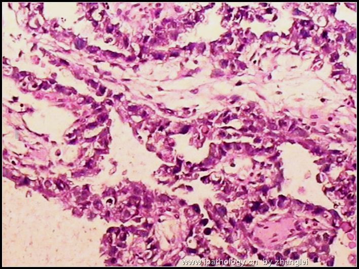 睾丸肿瘤－－卵黄囊瘤（yolk sac tumor）图4