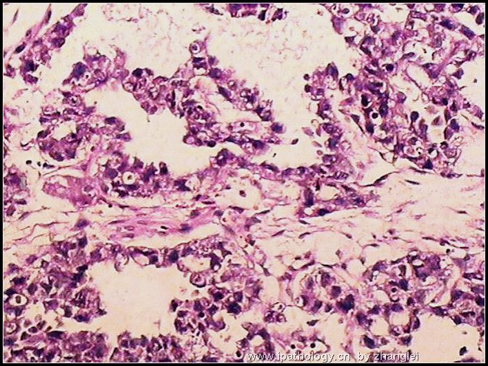 睾丸肿瘤－－卵黄囊瘤（yolk sac tumor）图5