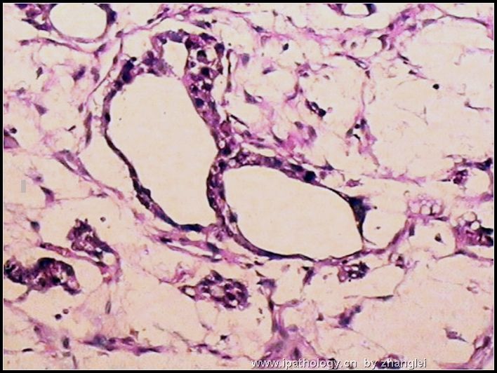 睾丸肿瘤－－卵黄囊瘤（yolk sac tumor）图6