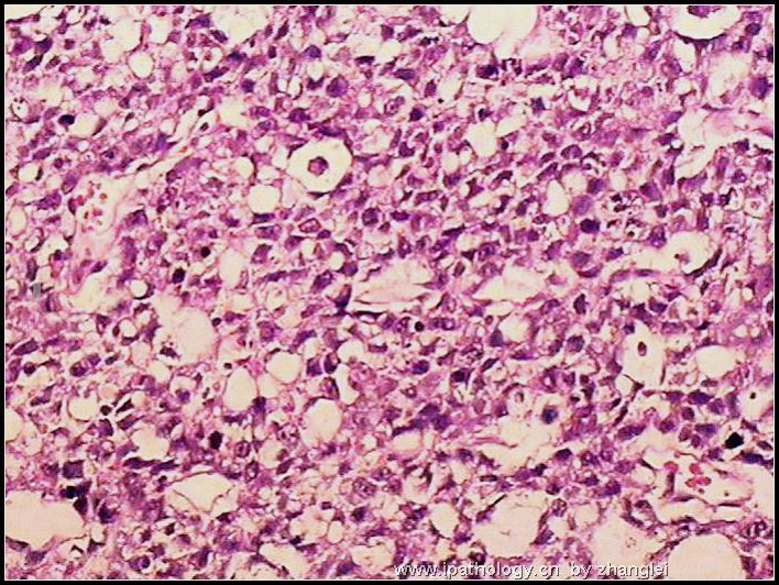 睾丸肿瘤－－卵黄囊瘤（yolk sac tumor）图7
