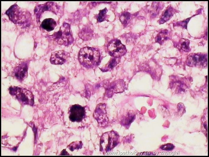 睾丸肿瘤－－卵黄囊瘤（yolk sac tumor）图8