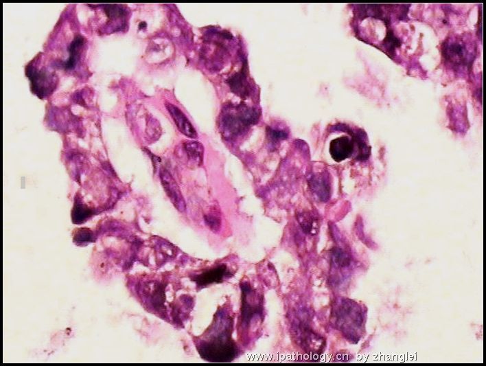 睾丸肿瘤－－卵黄囊瘤（yolk sac tumor）图9