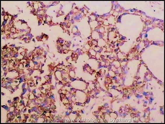 睾丸肿瘤－－卵黄囊瘤（yolk sac tumor）图10