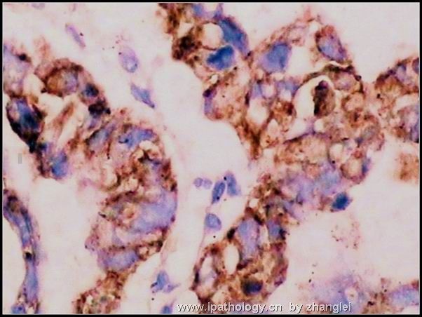 睾丸肿瘤－－卵黄囊瘤（yolk sac tumor）图11