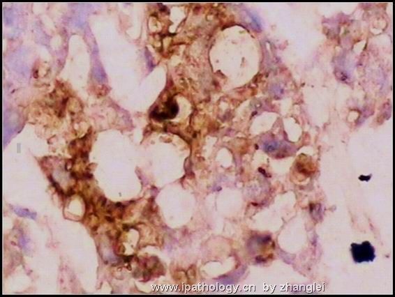 睾丸肿瘤－－卵黄囊瘤（yolk sac tumor）图12