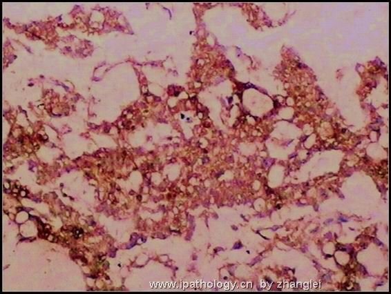 睾丸肿瘤－－卵黄囊瘤（yolk sac tumor）图13