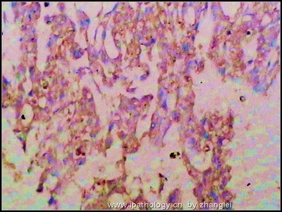 睾丸肿瘤－－卵黄囊瘤（yolk sac tumor）图14