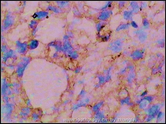 睾丸肿瘤－－卵黄囊瘤（yolk sac tumor）图15