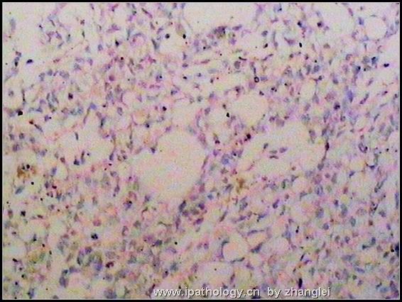 睾丸肿瘤－－卵黄囊瘤（yolk sac tumor）图16